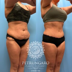 39F-Tummy-tuck-Lipo-360-&-Renuvion