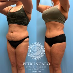 39F-Tummy-tuck-Lipo-360-&-Renuvion