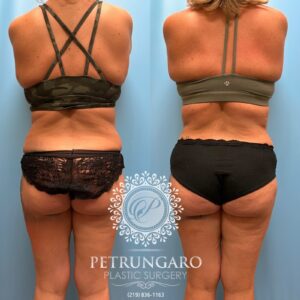 39F-Tummy-tuck-Lipo-360-&-Renuvion