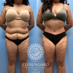 53F-Tummy-tuck-Lipo-360-Renuvion