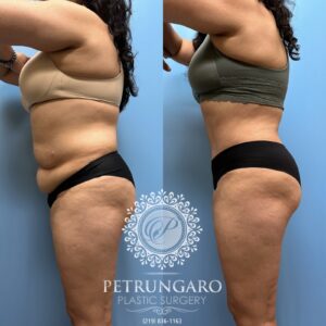 53F-Tummy-tuck-Lipo-360-Renuvion