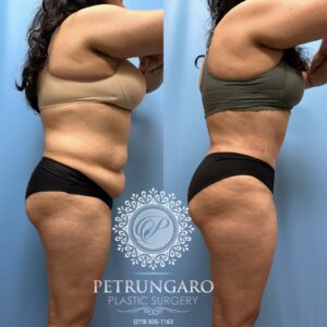 53F-Tummy-tuck-Lipo-360-Renuvion