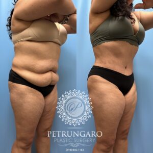 53F-Tummy-tuck-Lipo-360-Renuvion