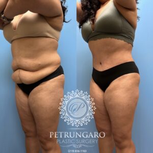 53F-Tummy-tuck-Lipo-360-Renuvion