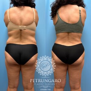 53F-Tummy-tuck-Lipo-360-Renuvion