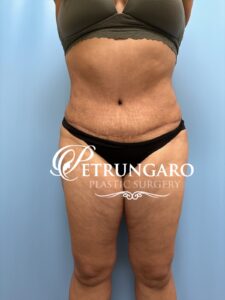 53F-Tummy-tuck-Lipo-360-Renuvion