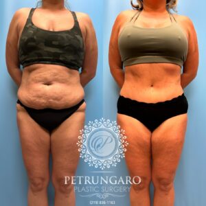 39F-Tummy-tuck-Lipo-360-&-Renuvion