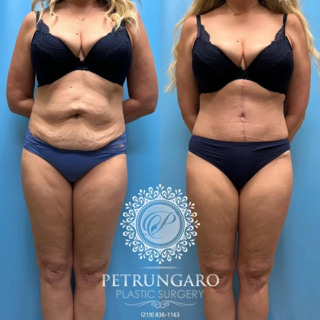 Breast Augmentation Chicago NW IN Petrungaro Plastic Surgery